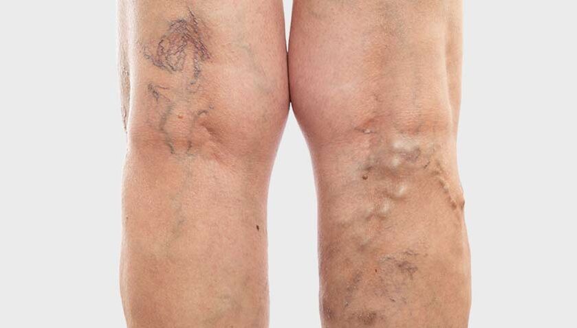Les varices affectent différentes veines