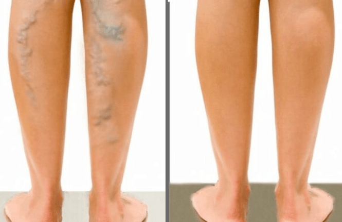 Varices avant et après la chirurgie