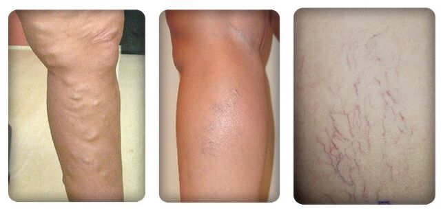 Phase des varices