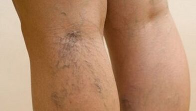 Les causes des varices