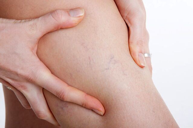 Les premières apparitions de varices sur la jambe